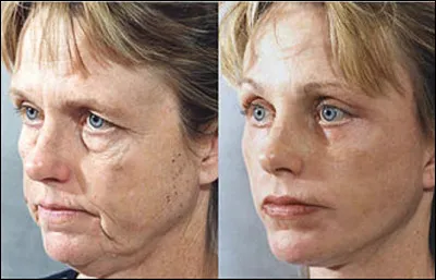 Quel est le nom de cette op&eacute;ration de chirurgie esth&eacute;tique destin&eacute;e &agrave; corriger les affaissements de la peau ?