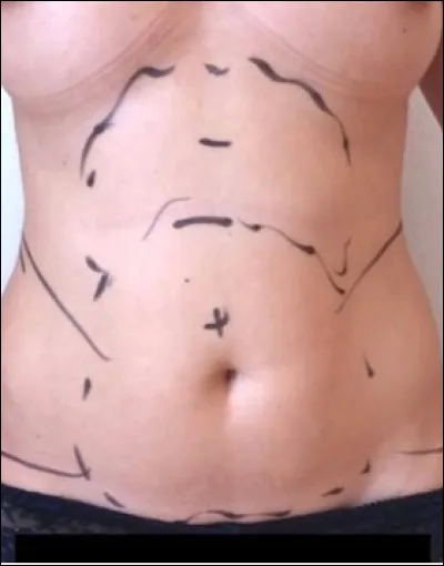 Quel est le nom de l'intervention chirurgicale qui consiste &agrave; enlever les amas graisseux ?