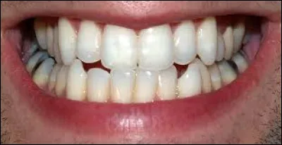TRENTE-DEUX - Dans une denture complète de 32 dents d'un être humain, quel type de dents est le plus nombreux ?