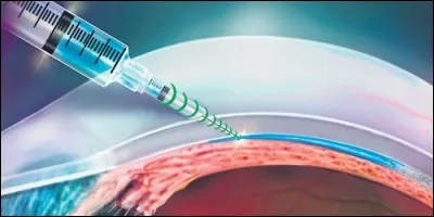 C'est une aiguille nouvelle génération, elle est capable de se diriger en évitant les organes sensibles, un animal l'a inspirée !