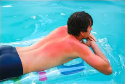 A force de s'exposer, il a attrapé un ... de soleil