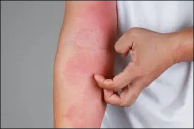 Sa peau souffre d'...