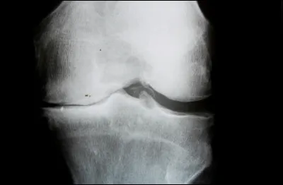 Quel est le nom de l'arthrose sp&eacute;cifique du genou ?