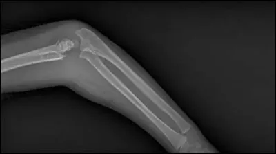 Comment s'appelle la phobie des factures ?