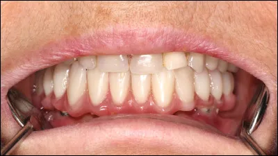 Combien de dents poss&egrave;de normalement un adulte ?