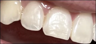 Combien de dents poss&egrave;de normalement un adulte ?