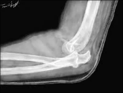 Les luxation répétées sont évidamment un signe de failure.