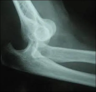 Déplacement articulaire très douloureux (mais je suis douillet ! )