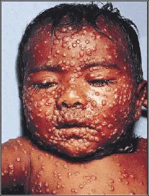 Qui a dcouvert le vaccin de la variole ?