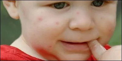 Laquelle de ces maladies est contagieuse ?