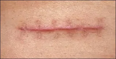 Avant la cicatrisation, il est préférable de bien nettoyer la plaie des tissus morts. Qu'est-ce qui pourra être efficace dans cette tâche ?