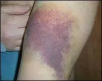 Son corps tait couvert d'quinoxes