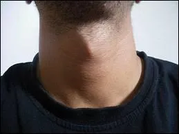 La pomme d'Adam dsigne la prominence que certains hommes ont sur la face antrieure du cou. Comment s'appelle l'acte chirurgical qui consiste  en rduire le volume ?