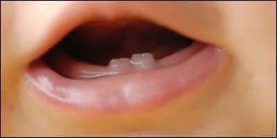 On peut avoir des dents dés la naissance.
