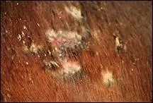 Lors d'un automne pluvieux, un cheval prsente des zones de poils hirsutes sur le dos qui le dmangent normment. Si on tire le poil, il y a une sorte de pus en dessous. De quoi peut-il s'agir ?