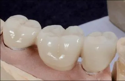 Cet appareil dentaire vous donnera le nom d'un jeu de cartes.