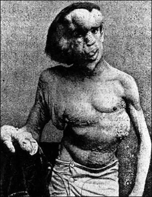 N en 1862, ce personnage atteint d'une grave maladie dformante a inspir le film 'Elephant Man', ralis par David Lynch :