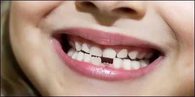 Combien l'homme possède des dents de lait ?