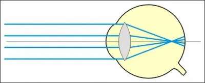 Qu'est-ce qu'un oeil myope ?