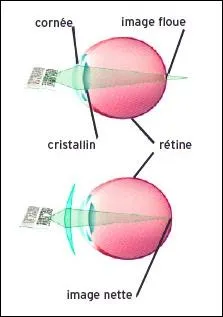 Qu'est-ce que la presbytie ?