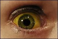 Quel est l'autre nom de la jaunisse ?