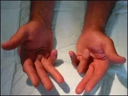 Chirurgien, j'ai laiss mon nom  une maladie qui entrane une flexion progressive et irrductible des doigts, je suis