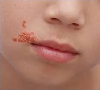 Les streptocoques ou les staphylocoques provoquent sur votre visage des vésicules à croûtes suintantes (horrible ! ).