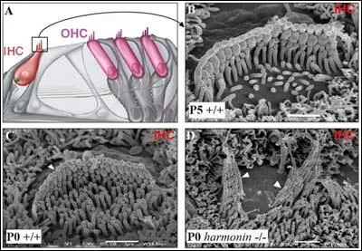 Une consommation abusive d'alcool chez une femme enceinte peut entraner le syndrome de Usher chez le nouveau n ?