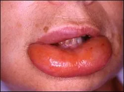 Comment appelle-t-on ce gonflement rapide des muqueuses dû à une allergie ?