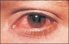 Laquelle de ces plantes permet de lutter contre la conjonctivite une inflammation des yeux ?