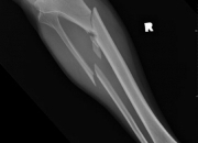 Quiz Fractures de jambe