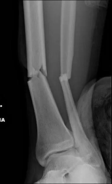 Un homme g de 25 ans prsente une fracture basse de jambe (radio) ouverte avec plaie de 12 cm. Quelle mesure serait indique pour amliorer le rsultat aprs clou centro-mdullaire ?