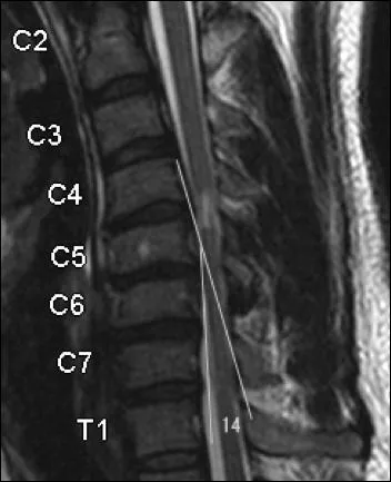 Un homme g de 56 ans prsente une dmarche mal assure et une maladresse manuelle. L'IRM donne les images suivantes. Quelle serait la tactique opratoire la plus approprie ?