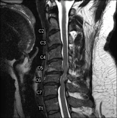 Cette femme ge de 63 ans prsente dmarche mal assure, maladresse manuelle et rflexes tendineux exagrs aux jambes. Traitement ?