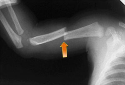 Fracture d'un os long chez un enfant avant l'ge de la marche. Que proposer ?