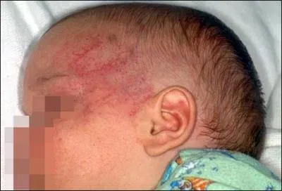 Accident de voiture  4 ans avec rate rompue, fractures ouvertes des fmurs, paralysie par clatement de vertbre lombaire et trauma cranien svre. Des squelles durables seraient surtout lié