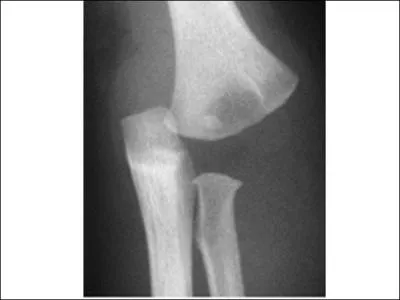 Garonnet de 2 ans, aux 'urgences' avec mal au coude gauche. La lsion vue sur cette radio amnerait  voquer :