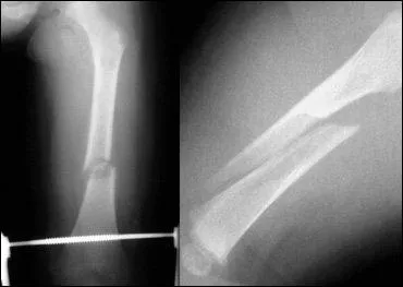 En cas de fracture isole spiroide de la fracture du fmur, un svice  enfant serait  voquer dans quel contexte ?