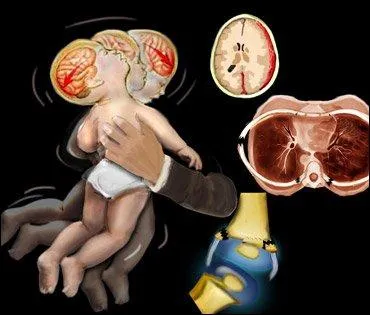 Quel serait le sige des deux lsions les plus communes en cas de svice  enfant ?