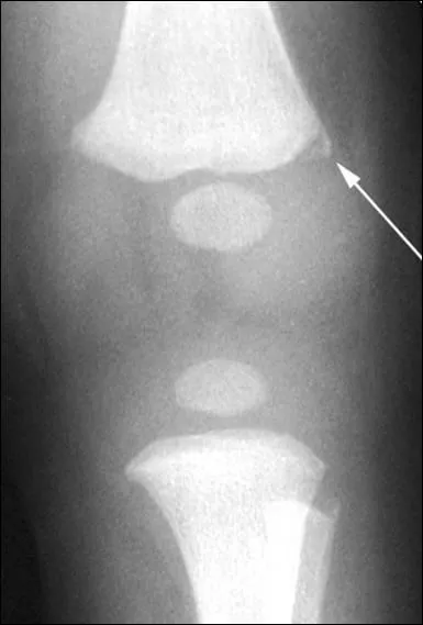 Aux 'urgences' avec sa mre, ce nourrisson de 6 mois irritable depuis une semaine depuis une possible chute de la table de change a son genou radiographi ('corner fracture'). Que proposer ensuite ?