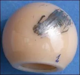 Pose de PTH, femme, 36 ans, squelles post-traumatiques, couple cramique/polythylne. En per-opratoire, la tte du fmur en alumine, heurte la cupule en titane (image). COMPLICATION TARDIVE ?