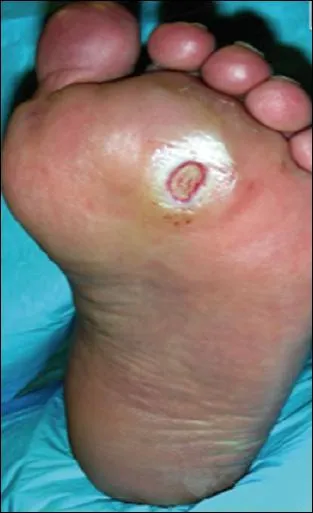 Ulcration du 'pied diabtique' chez un homme de 65 ans sans exposition de l'os, sans signes d'infection et  bon (gros) pouls. Quel autre examen serait des plus indiqus ?