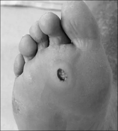 Ulcration rebelle (au 'total contact cast') depuis 8 mois chez un diabtique de 44 ans. Sensibilit diminue, pas de signe d'infection, pouls artriel bon mais rtraction des jumeaux. Quel traitement ?