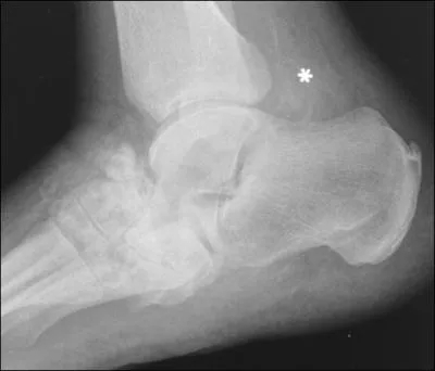 Chez ce diabtique de 57 ans sous metformine et gabapentine, l'ulcre au milieu du pied parat 'propre' : la radio (ci-jointe) correspond  quelle 'maladie' ?