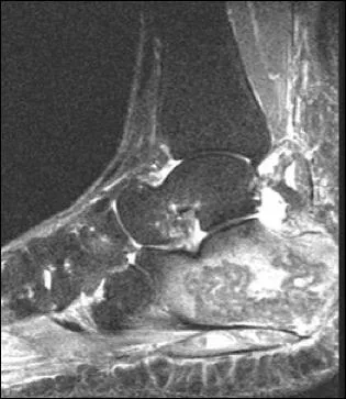 Chez un diabtique de 45 ans avec une ulcration (4X2 cm) peu douloureuse du talon rebelle aux mises  plat, les pouls au pied sont bien perus. Aprs IRM