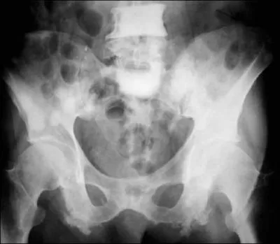 Radio pour mal de dos croissant depuis 6 mois, chez un gardien de prison, retrait de 67 ans sans mdecin depuis 15 ans, amaigri de 7 kilos sans rgime, asthnique, fumeur ancien. Que proposer ?