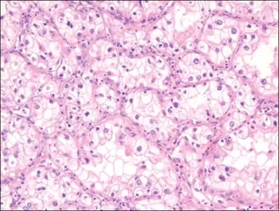 Douleur croissante du genou depuis un an chez cette femme ge de 53 ans en bon tat gnral. L'IRM voque plusieurs diagnostics, mais l'histologie (coupe jointe) est en faveur de :