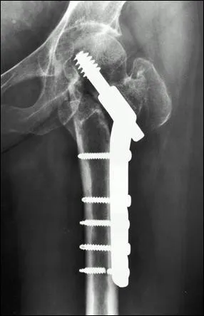 Homme 65 ans : 3 mois aprs fixation par vis-plaque tlscopique de fracture intertrochantrienne oblique inverse, la radio est la suivante. Que ne doit-on pas faire, en cas de consultation pour deuxime avis ?