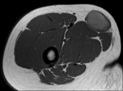 La coupe IRM montre une tumeur au sein de l'un des muscles de la cuisse. Quel nerf innerve ce muscle ?