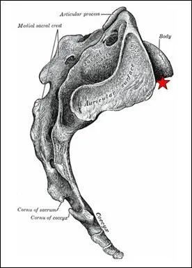 Pour fixer une disjonction entre aile iliaque et sacrum, si le trajet de la vis dirige S1 passe auprs de l'toile rouge (schma), Quelle paralysie peut-on observer ?